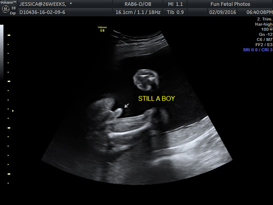 Fun Fetal Photos 2D Ultrasound Gender Determination